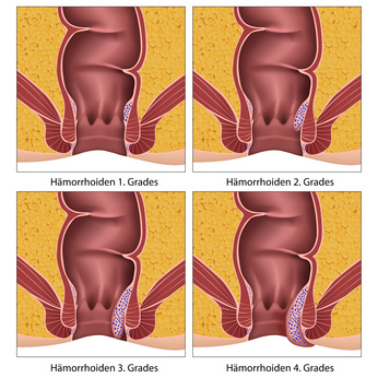 Kokosöl Hämorrhoiden