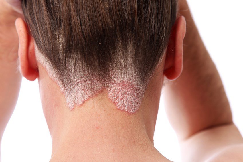 Psoriasis Schuppenflechte