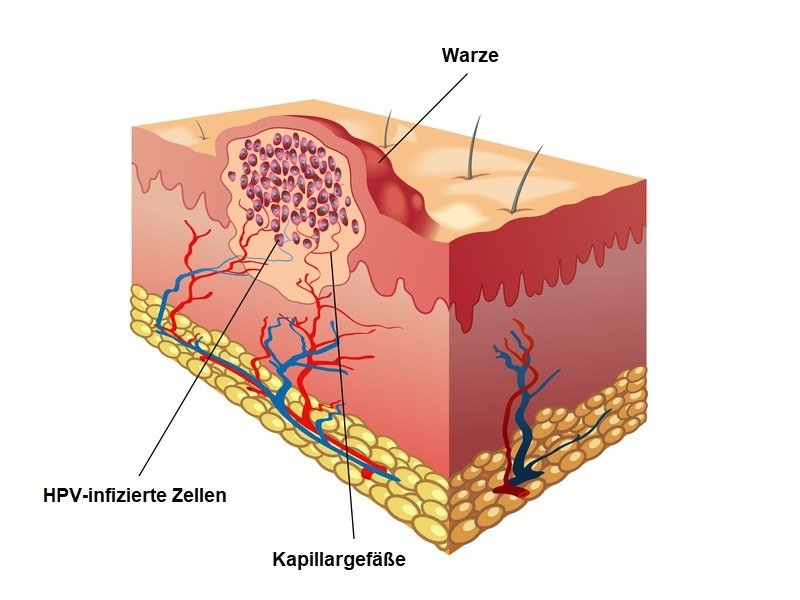 Kokosöl Dornwarze